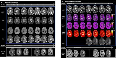 MR-Guided Radiotherapy for Brain and Spine Tumors